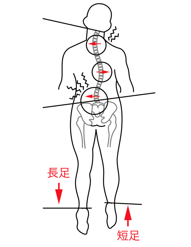 背骨・骨盤の歪みの絵